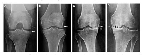 Figure 1 from Imaging for osteoarthritis. | Semantic Scholar