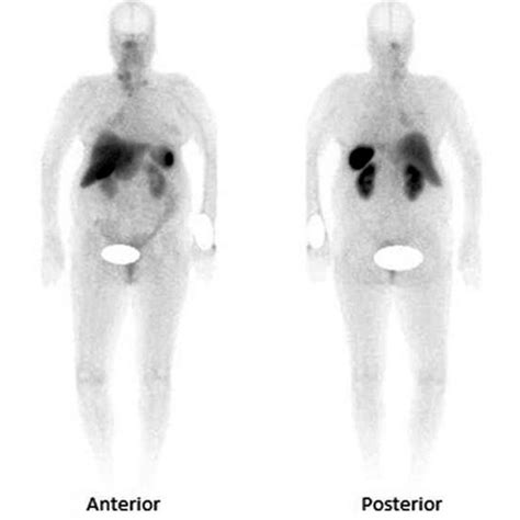 Whole-body octreotide scan revealed multiple zones of octreotide avid ...