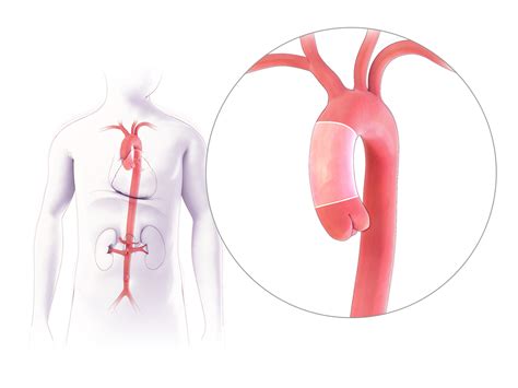 Emory Aortic Center | Patient Education