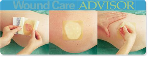 Hydrocolloid Dressing Pressure Ulcers