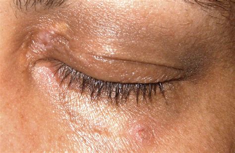 xanthelasma removal surgery