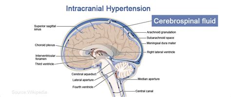 Intracranial Hypertension