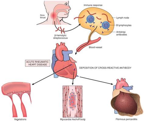 Rheumatic Fever Pathogenesis