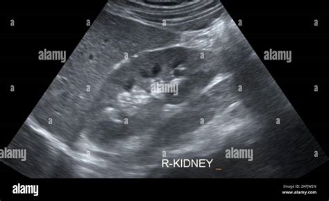 Normal Kidney Ultrasound