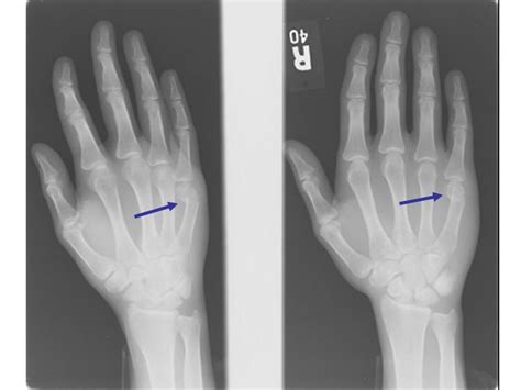 Ulnar Gutter Splint