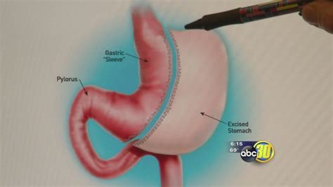 Gastric sleeve offering promise to many weight-loss surgery patients ...