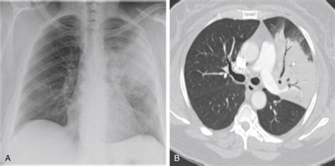 Segmental and Lobar Consolidations | Radiology Key