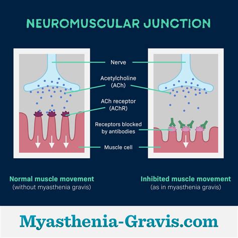 Acetylcholine Receptor Myasthenia Gravis