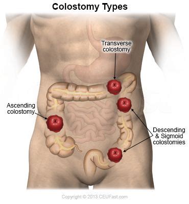 CEUfast.com - Colostomy stoma types and locations | Colostomy, Ostomy care, Wound care nursing