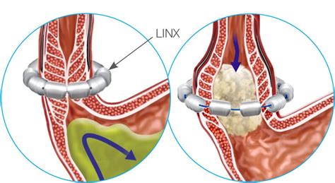 LINX for Relux in Shreveport. Stop GERD.