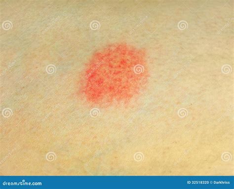 Skin Disease Stock Photo - Image: 32518320