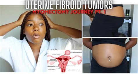 Uterine Fibroid Removal Weight Loss | Blog Dandk