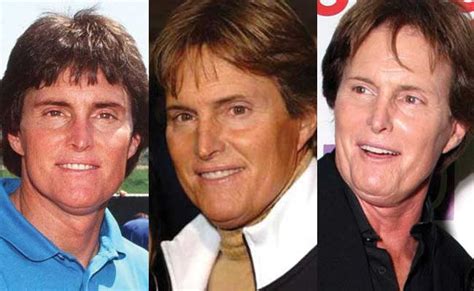 Bruce Jenner Plastic Surgery Before and After Pictures 2024