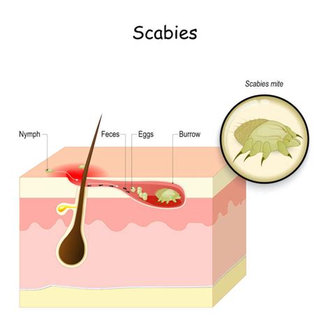 Scabies: Causes, Rash Signs & Treatment Options