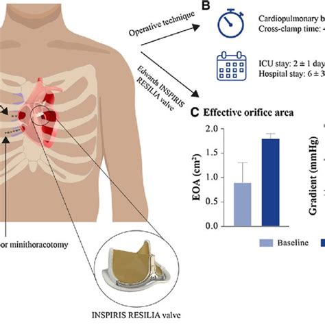 Outcomes following implantation of INSPIRIS RESILIA aortic valve via ...