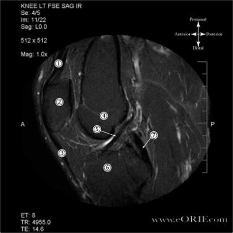 ACL Anatomy | eORIF