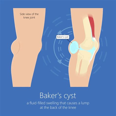 What You Need to Know About Baker's Cysts: Causes, Symptoms, and Treatment | Jeremy Burnham, MD