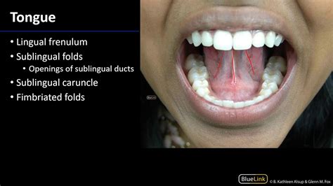 Sublingual Caruncle Swelling