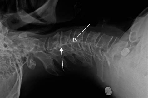 Retrolisthesis: Types, causes, and symptoms