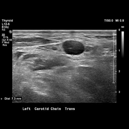 lymph node anatomy pics