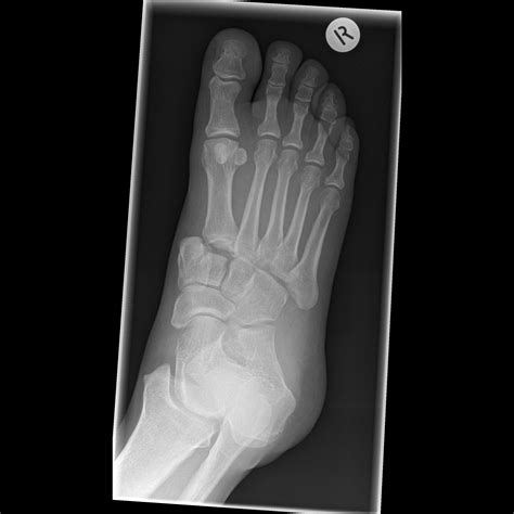 Lisfranc fracture-dislocation | Image | Radiopaedia.org