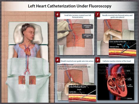 Left Heart Catheterization Under Fluoroscopy - Trial Exhibits Inc...