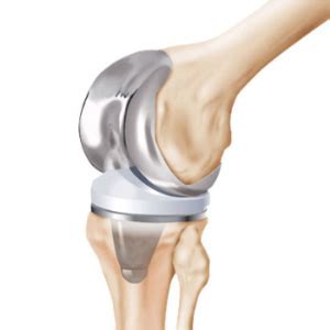 DePuy Knee Problems | Defective DePuy Knee Systems