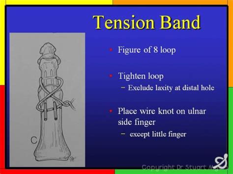 Tension Band Wiring