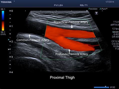 Doppler waveform in femoral artery before and after the exercise on ...