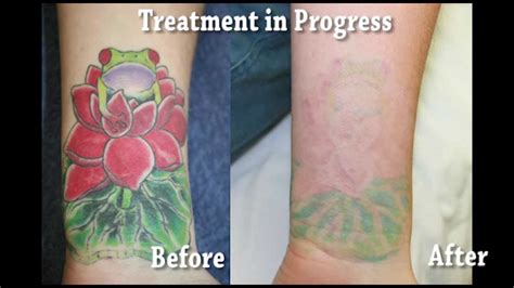 Remove Tattoo Before After | safe and effective tattoo removal