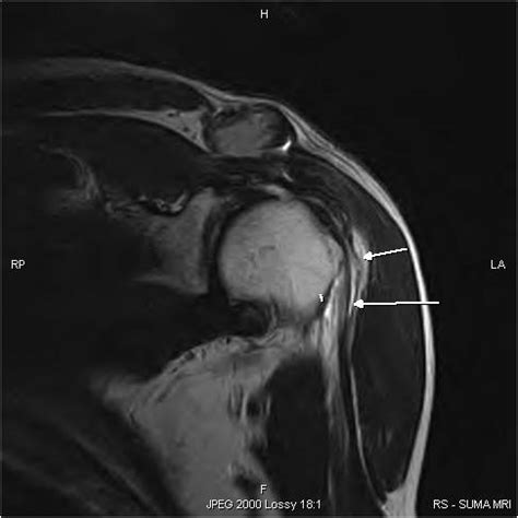 Long head of Biceps Rupture-MRI - Sumer's Radiology Blog