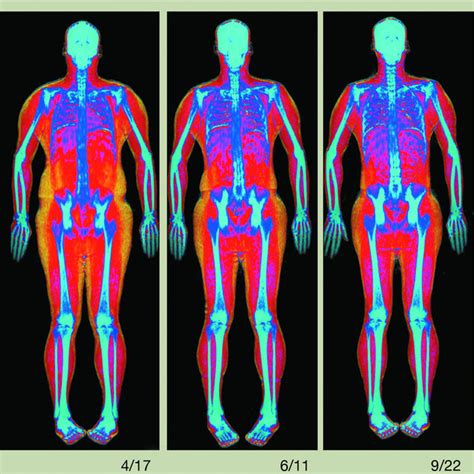 Too Much Fat? Try a Whole-Body Scan - WSJ