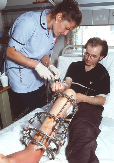 Broken leg - Stock Image - M330/0875 - Science Photo Library