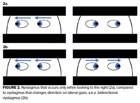 The Well-Appearing Patient with Acute Dizziness – Sinai EM