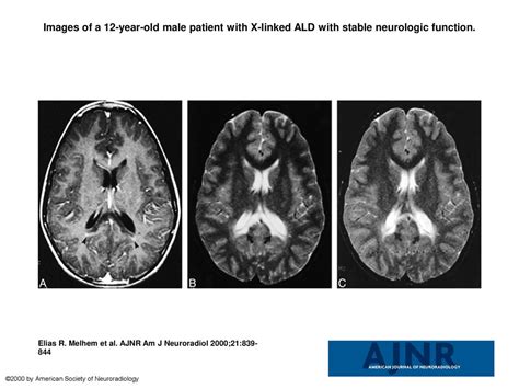 Images of a 12-year-old male patient with X-linked ALD with stable neurologic function. Images ...