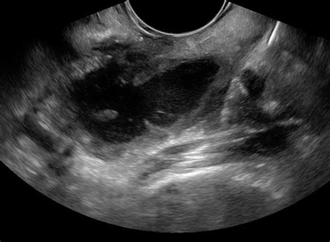 Bedside Ultrasound for the Diagnosis of Peritonsillar Abscess - JETem