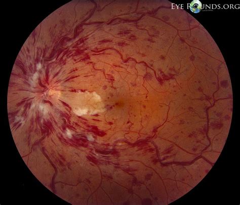 Flame hemorrhages with cotton wool spotsFlame-shaped Hemorrhage ...