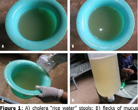 Figure 1 from Cholera -“Rice water stools | Semantic Scholar