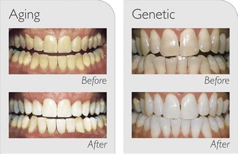 Zoom whitening before and after photos - jzaev