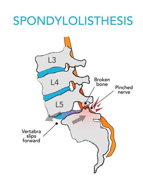 Complete Car Physio - Spondylolisthesis Exercises