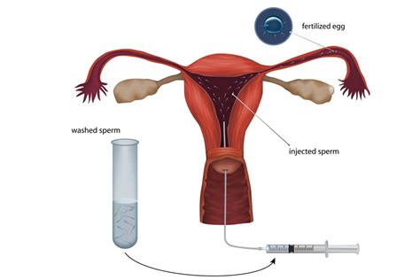 Artificial Insemination - Process, Pros and Cons - Being The Parent