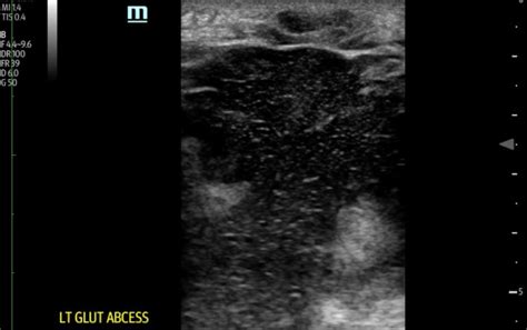 Gluteal Abscess, Ultrasound. JETem 2018 - JETem