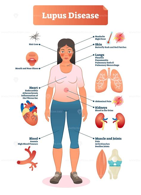 Lupus disease vector illustration - VectorMine