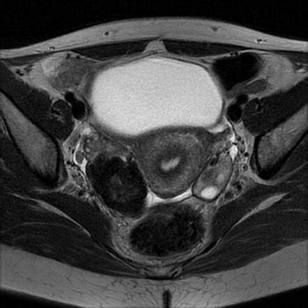 Ovarian fibroma | Radiology Case | Radiopaedia.org