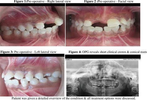 Figure 3 from Prosthodontic Management of True Generalised Microdontia in Pituitary Dwarfism – A ...