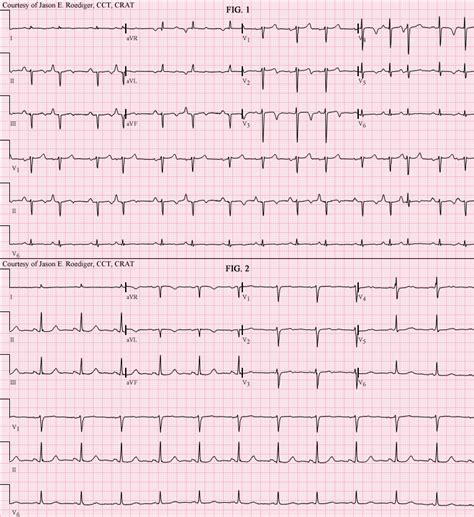 Schamroth's sign | ECG Guru - Instructor Resources