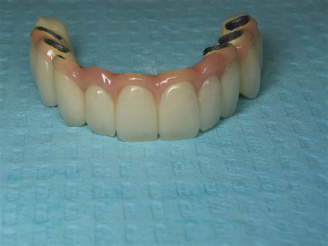 Fixed Dental Implant Bridge vs. Implant Denture - What is the REAL ...