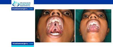 Cleft palate surgery complications - Iranian Surgery