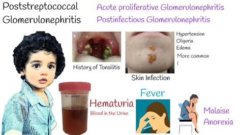 Acute proliferative Glomerulonephritis (Poststreptococcal ...