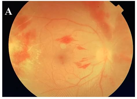 IJMS | Free Full-Text | Recent Updates on Treatment of Ocular Microbial ...